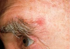 Learn the warning signs for basal cell carcinoma and view images to see what it looks like, to help you detect skin cancer early. Cancerous Moles, Kidney Detox, Basal Cell, Skin Moles, Squamous Cell, Learn Yoga, Skin Disorders, Natural Therapy, Skin Diseases