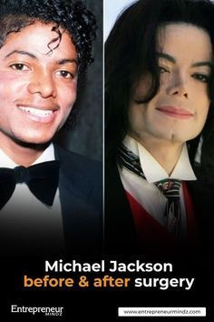 michael jackson before and after surgery