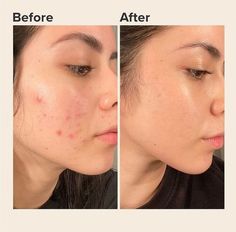 Acne Solutions, روتين العناية بالبشرة, Skin Care Solutions, Acne Skin, Glass Skin, Skin Care Treatments, Skin Rejuvenation, Skin Treatments, Retinol