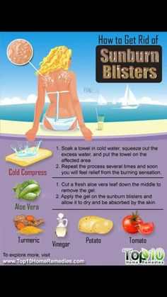 Sunburn Blisters, Home Remedies For Sunburn, Get Rid Of Sunburn, How To Treat Sunburn, Heal Sunburn, Sunburn Remedies, Sunburn Relief, Top 10 Home Remedies, Natural Acne Remedies