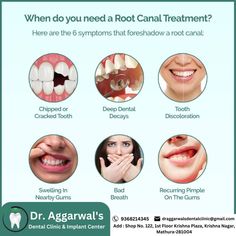 Root canal treatment is needed when dental X-rays show that the pulp has been damaged by a bacterial infection. Dental Post, Dental Quotes, Dental Images, Dental Videos, Dental Photography