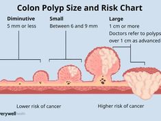 Colon Polyp Size Chart to Gauge Risk - NewsBreak Eye Health Food, Age 50, Medical News, Belly Workout, Flat Belly, Size Chart, Health