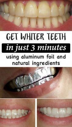 Baking Soda Teeth Whitening, Dental Health Care, Nice Teeth, Dental Cosmetics, Oral Care Routine, Receding Gums