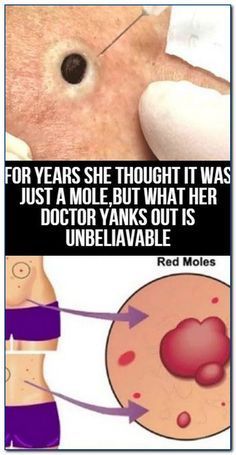 Red Moles, Medical Herbs, Tips For Losing Weight, Rid Of Blackheads, Nutrition Food, Get Rid Of Blackheads, Hoco Makeup, Ear Wax