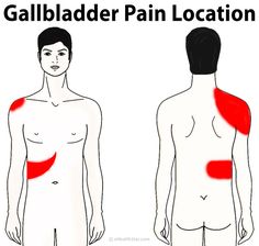 Gallbladder Removal Diet, Gallbladder Cleanse, Gallbladder Surgery, Gall Bladder, Referred Pain