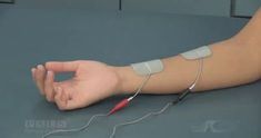 Electrical stimulation, also referred to as e-stim, NMES, or FES, can be an effective tool in reducing the symptoms of stroke, such as increasing strength and function. The success of one’s recovery using electrical stimulation will rely heavily on proper electrode placement. Listed below are some key video examples of upper limb electrode positioning by Axelgaard. … Ulnar Nerve, Knee Pain Exercises, One Month