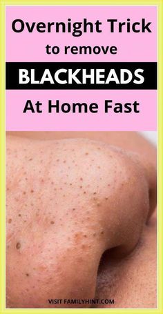 How to Remove Blackheads with the  - Help of a Toothbrush by deana happ | This newsletter was created with Smore, an online tool for creating beautiful newsletters for educators, businesses and more Gallbladder Health, Natural Remedies For Cough, To Remove Blackheads, Blackhead Mask, Remedies For Cough, Reading More