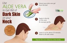 Here are some causes of dark skin on the neck and ways to get rid of the same. Dark Patches On Skin, Dark Neck, Aloe Vera Moisturizer, Throbbing Headache, Aloe Vera For Skin, Skin Patches, Skin Remedies, Skin Care Remedies