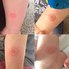 Are tick bites itchy? Do they always cause a rash? Here are the telltale symptoms of a tick bite, plus pictures that can help you identify one if you suspect you've been bitten. Tick Bites On Humans, Tick Bites Pictures, Tick Bite Rash, Tick Bite Symptoms, Stop Itching Skin Insect Bites, Diy Itch Relief Insect Bites, How To Remove A Tick From A Human, Wood Tick, Bug Bite Itch