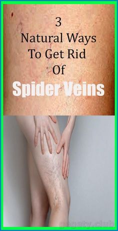 Get Rid Of Spiders, Varicose Vein Remedy, Spider Webs, Unwanted Hair Removal, Hormonal Changes, Natural Treatments, Pain Free, Blood Vessels, Health Remedies