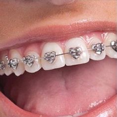 Smile With Braces, Fake Braces, Braces Girls, Brace Face