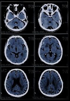 multiple images of the brain showing different areas