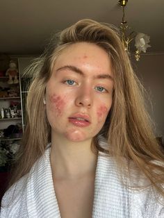 #акне #девушкасакне #девушкаэстетика Acne Aesthetic Girl, Girl With Acne Aesthetic, Pretty People With Acne, Girls With Acne, Acne Pretty, Acne Girl