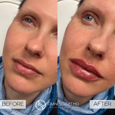 Lip Injection Before & After Gallery | OMNI SCULPT MD