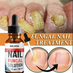 Stay away from the gray nails, make your nails more healthy and beautiful! Here is a detailed guide to nail care for all your intermediate nail care needs! Description:Nail fluid barbs from cracking to gray nails Product name: Nail fluid Specification: 30 ml Properties: Liquid It moisturizes the skin, spiny growth around the nails, softens the skin and keeps nails healthy and shiny. Massage to complete absorption, can make the finger edge skin without barbs and skin. fluid are very good for your Toenail Fungal Infection, Nail Polish Painting, Nail Infection, Fungal Nail, Nail Repair, Damaged Nails, Ingrown Toe Nail, Gray Nails, Nail Growth