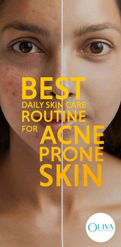 How to get a clear skin? The goal of your skin care regimen should be to control and reduce acne. Know the daily skin care routine - cleanse, exfoliate, tone, moisturize, makeup tips to follow if you have acne prone skin. Daily Skin Care Routine For Acne Prone Skin, Acne Prone Skin Care Routine, Oily Skincare, Skin Care Routine For 20s, Acne Skincare, The Best Skin Care, Perfect Skin Care Routine