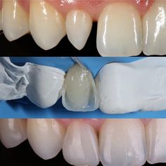 Dentaltown - "Peg Lateral" is the dental term use to describe small or underformed lateral incisors. It is a surprisingly common defect in teeth and may present in one or both of the lateral incisors. Dental Ceramics, Dental Photos, Dental Aesthetics, Dental Hygiene School, Dental Work