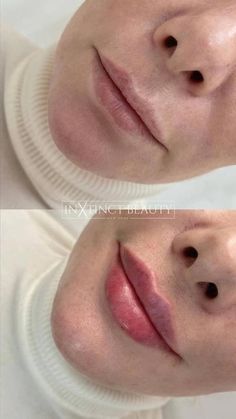 1ml Lip Filler, Russian Lips, Aesthetic Dermatology, Lip Augmentation, Cosmetic Dermatology, Lip Filler, Dark Underarms, Aesthetic Medicine