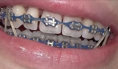 Dark Blue Braces, Braces Colors Combinations, Cute Braces Colors, Braces Tips, Grillz Teeth, Getting Braces, Braces Girls, Cute Braces, Brace Face