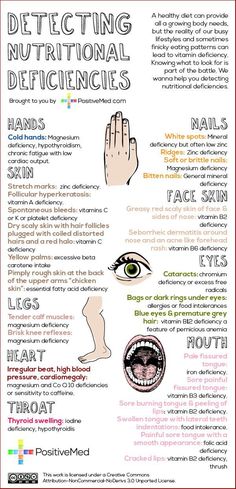 Detecting Nutritional Deficiencies -- A healthy diet can provide all a growing body needs, but the reality of our busy lifestyles and sometime finicky eating patterns can lead to vitamin deficiency. SYMPTOMS are actually better indicators of nutritional deficiency than signs. Nutrition Sportive, Nutritional Deficiencies, Body Health, Healthy Tips, Holistic Health, Healthy Body, Health And Nutrition