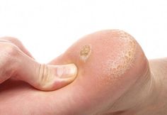 Plantar Wart Removal, Warts On Hands, Home Remedies For Warts, Remove Skin Tags Naturally, Warts Remedy, Varicose Vein Remedy, Skin Growths, Get Rid Of Warts, Callus Removal