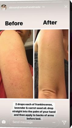 Bumps On Arms, Obličejové Masky, Routine Skin, Natural Organic Skincare, Organic Skin, Healthy Skin Care, Beauty Skin Care Routine, Health And Beauty Tips, Anti Aging Skin Products