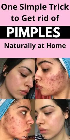 Remedies For Pimples On Face, How To Treat Pimples, Red Skin Spots, Pimple Solution, Rid Of Pimples