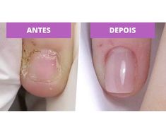 Você está cansado(a) de roer as unhas e deseja ter unhas bonitas e saudáveis? Neste post, compartilho dicas valiosas para ajudá-lo(a) a superar o hábito de roer unhas. Descubra alternativas saudáveis, cuidados especiais e a motivação necessária para transformar suas mãos. Venha se juntar a nós nesta jornada de beleza e confiança. #UnhasBonitas #Superação #BelezaDasMãos" Nail Extensions For Short Nails, What To Do With Short Nails, Polygel Square Nails, Acrylic Nails On Bitten Nails, Polygel On Bitten Nails, Short Acrylic Nails For Nail Biters, Natural Looking Gel Nail Extensions, Short Sculpted Acrylic Nails, Nail Designs For Bitten Nails