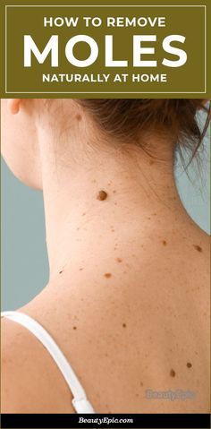 Mole Removal At Home, Remove Moles Naturally, Laser Mole Removal, Moles On Face, Remove Moles, Natural Beauty Remedies