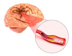 Aneurysm: Causes, symptoms, and treatments Medicine Art, Subarachnoid Hemorrhage, Food Work, Brain Surgeon, Brain Anatomy, Double Vision, Healthy Exercise, Body Tissues, Healthy Benefits