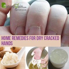 Foot Detox Soak, Best Skin Cream, Chapped Hands, Dry Skin Body, Allergy Remedies, Herbal Teas Recipes