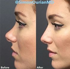 Nonsurgical Nose Job, Bulbous Nose, Plastic Surgery Gone Wrong, Hyaluronic Acid Fillers