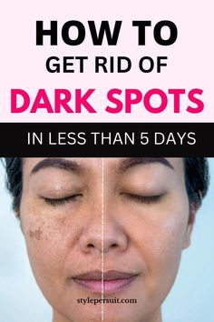 Skin Spots On Face, Blackspot Remedies, Pumpkin Zucchini, Dark Spot Remover