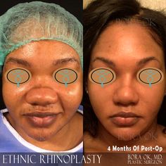 African Nose, Jaw Reduction Surgery, Korean Plastic Surgery, Beauty Procedures