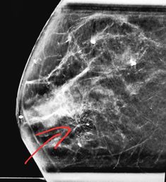 3D #tomosynthesis #mammography: architectural distortion signifying breast cancer. #radiologist #radiology #breastcancer   This information is for educational purposes. There is no individually identifiable health information. De-identification of protected health information has been performed. Radiology Imaging, Diagnostic Imaging, Health Information, Radiology, Women's Health, Ultrasound, Womens Health, Paloma, Architecture