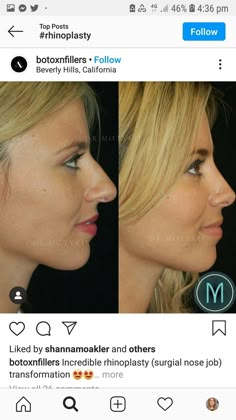 Nose Plastic Surgery, Nose Surgery Rhinoplasty, Nose Fillers, Bulbous Nose, Rhinoplasty Nose Jobs, Face Surgery, Rhinoplasty Before And After, Job Inspiration, Straight Nose