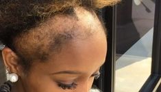 do box braids damage hair Bald People, Alopecia Hairstyles, Traction Alopecia, Edges Hair, New Hair Growth, Grow Long Hair, African American Hairstyles, Beauty Makeup Tips, Hair Regrowth