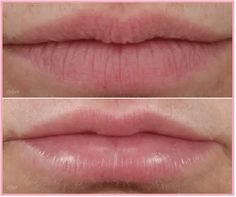 Smoker Lines Before And After, Lip Filler For Smoker Lines, Lip Fillers Before And After, Lip Line Filler, Best Lip Plumping Gloss, Upper Lip Wrinkles, Smokers Lines, Reverse Aging Skin