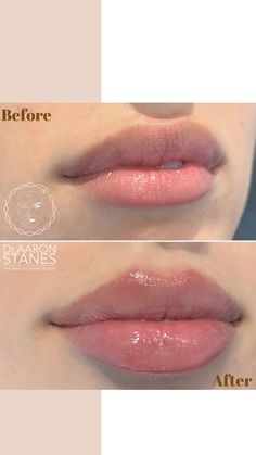 A proper lip augmentation must be bespoke. There is no one size fits all approach and everyone may need different types and different quantities of filler to achieve their goals in a way that is harmonious with the face. When lip filler is done properly and with care, there should be minimal pain, if your lip augmentation is particularly painful then it might not be being done correctly. Bottom Lip Filler, Full Lips Makeup, Lip Filler, Lip Augmentation