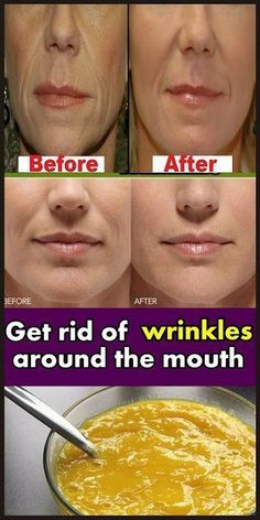 How To Remove Deep Mouth Wrinkles Really Fast Skin Care Routine For 20s, Unwanted Hair Removal