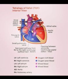 tof,Tetralogy of Fallot, cardiology, cardiac Tetralogy Of Fallot, Medical Drawings, Heart Rhythm, Junior Doctor, Heart Anatomy, Heart Defect