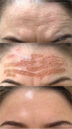 Fibroblast Skin Tightening — AskCares Skin Tightening Procedures, Tighten Facial Skin, Face Lift Surgery, Facial Fillers, Facial Contouring, Facial Aesthetics, Injectables Fillers