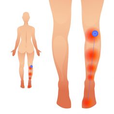 Trigger points in Plantaris are often associated with &quot;unexplained&quot; pain at the back of the knee  Trigger Points and Knee Pain - Overview     Any therapist Soleus Muscle, Trigger Point Release, Pressure Point Therapy, Inner Knee Pain, My Knee Hurts, Swollen Knee