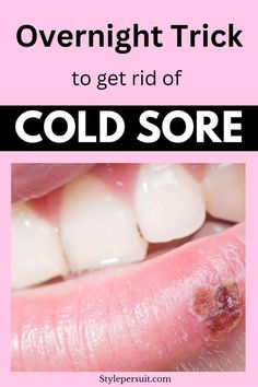 Cold Sore Remedy Overnight, Blister Remedies, Natural Cold Sore Remedy, Cold Sore Prevention, Cold Sores Remedies