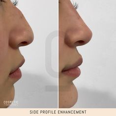 Have you ever wondered what your side profile could look like if it was more harmonised? Here’s a hint: it’s probably going to be amazing.⁠ ⁠ As pictured here - this patients nose, lips and chin were treated to create full harmonisation of the profile. Confidence looks good® Lip Filler Side Profile, Lips Side Profile, Romantic Partner, Clear Healthy Skin, Blood Sugar Diet, Shape Of You