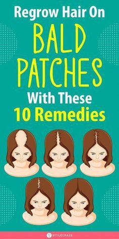 There are some easy home remedies that can assist you in naturally regrowing hair on bald patches. Here are 10 effective home remedies to help you regrow hair. Bald Patches, Regrow Hair, Home Remedies For Hair, Hair Control