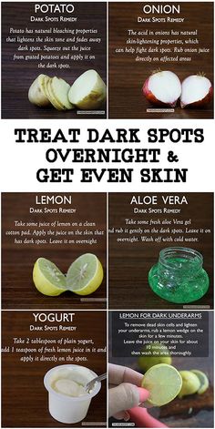 Almost all of us have some or the other kind of dark spots on the face. Dark spots are also known as freckles, sunspots, age spots etc. and are caused by exc... Dark Spots Remedies, Fresh Aloe Vera Gel, Black Heads, Brown Spots Removal, Skin Spots, Beauty Tips For Glowing Skin, Baking Soda Shampoo, Cold Remedies