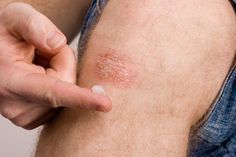 These are the most common causes of red spots on your skin, including psoriasis, keratosis pilaris, also known as chicken skin, rashes, and more, as explained by dermatologists and doctors. Red Rashes On Skin, Skin Rashes Pictures, Leg Rash, Red Skin Spots, Fungal Rash, Red Rash, Heat Rash, Skin Bumps