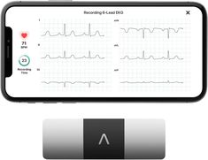 Amazon.com : KardiaMobile 6-Lead Personal EKG Monitor – Six Views of The Heart – Detects AFib and Irregular Arrhythmias – Instant Results in 30 Seconds – Works with Most Smartphones - FSA/HSA Eligible : Sports & Outdoors Sinus Rhythm, Normal Sinus Rhythm, Pulse Oximeters, Heart Rhythm, Normal Heart, Heart Rhythms, Cardiology, Coupon Book, Tech Trends