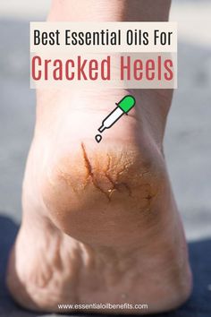 Healing Cracked Heels, Seasickness Remedies, Essential Oils For Nails, Cracked Heels Remedy, Cracked Heel Remedy, Essential Oils Logo, Cracked Heel Remedies, Healing Tips, Cracked Heel